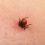 Complementary Lyme Disease Treatment